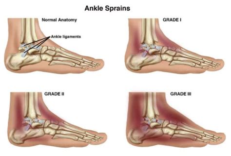 Pictures Of Sprained Foot A Sprain A Twist Or A Roll Decipher Your