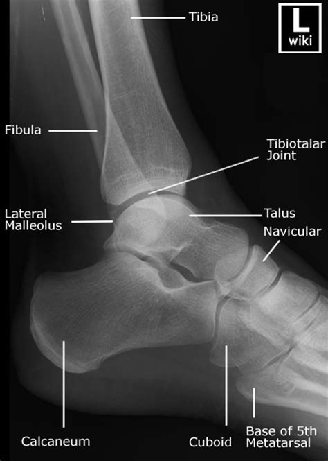 Elbow Radiographic Anatomy Wikiradiography Medical Anatomy The Best
