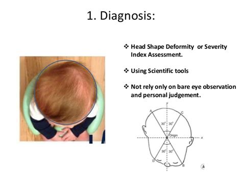 It is a condition with various levels the success rate for this form of treatment is high. Plagiocephaly Measurement with Craniometer: Diagnosis ...