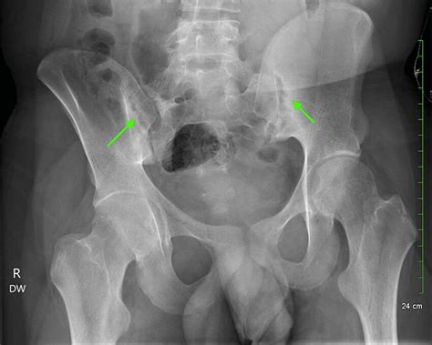 Bilateral Hip And Sacroiliac Joint X Ray Demonstrating Joint Space
