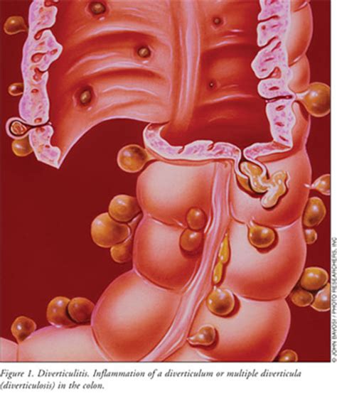 Diverticulitis Overview And Management