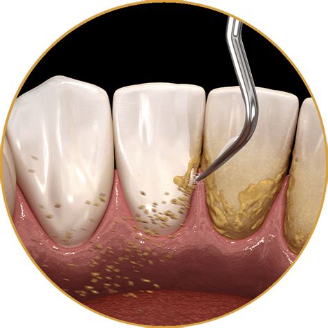 Osseous Surgery Kennewick Wa Tri Cities Periodontics And Implants