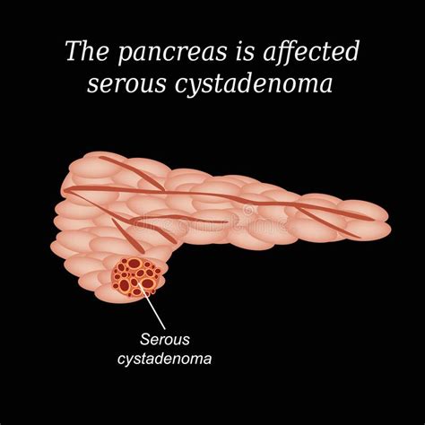 The Pancreas Is Affected Dense And Papillary Epithelial Tumors Vector