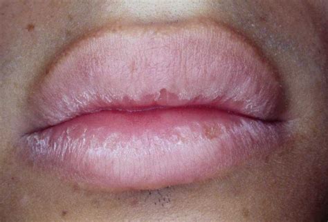 Dry Lips With Scaling And Crusting Particularly Involving The Vermilion