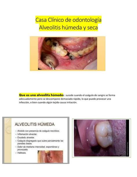 Caso Clínico De Odontología Alveolitis Húmeda Y Seca Camiii Udocz