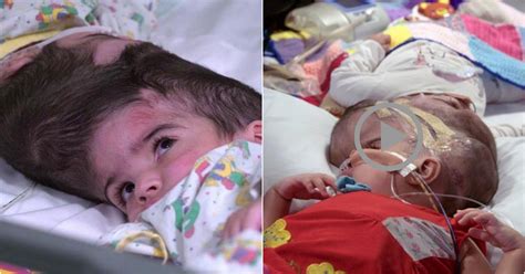 Rare Craniopagus Twins Successfully Separated After 50 Hour Surgery