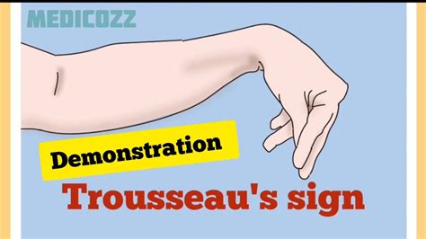 Trousseau S Sign In Hypocalcemia Patient Video Causes Treatment