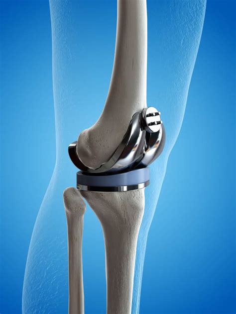 Knee Replacement Lawsuit Shield Legal Network