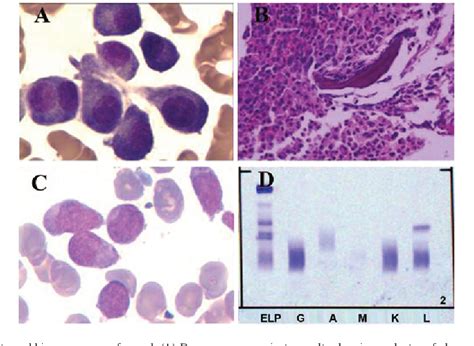 Figure 1 From Concurrent Chronic Neutrophilic Leukemia Blast Crisis And