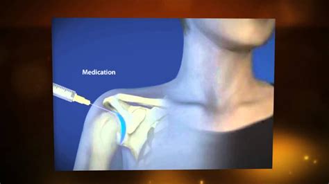 Shoulder Joint Injection Tampa Pain Physicians 813 961 1314 Youtube