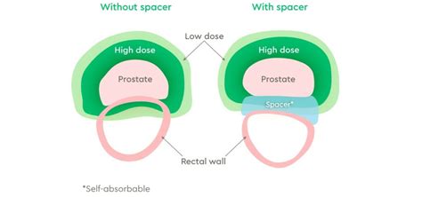Spacers For Prostate Cancer Radiation Therapy Genesiscare Au