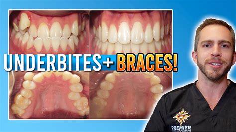 Underbite Braces Treatment W Rubber Bands Before And After Youtube