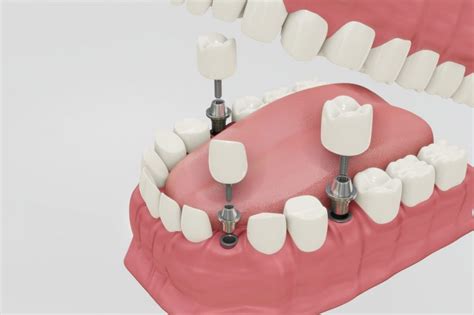 Implantes De Carga Inmediata En Carmona Clínica Dental Fades