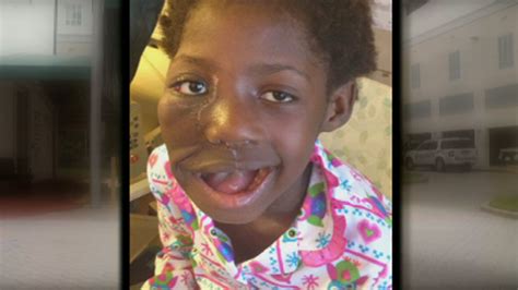 haitian girl has massive tumor removed by south florida doctors nbc 6 south florida