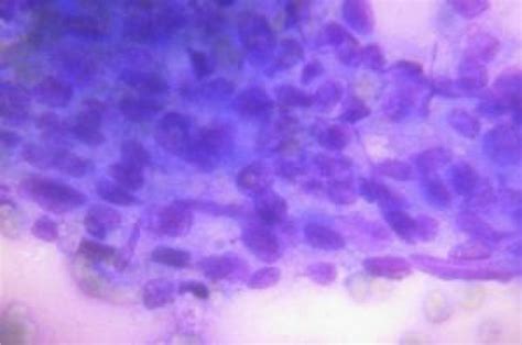 Cytologic Smear Of Supraclavicular Lymph Node Showing Metastatic