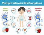 Multiple Sclerosis (MS) Symptoms Information Infographic Stock Vector ...