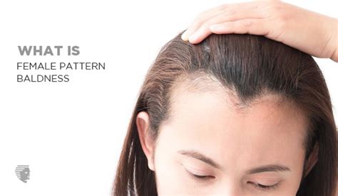 Female Pattern Baldness Symptoms Causes Treatment And Prevention