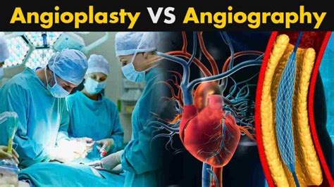 Explore 15 Key Difference Between Angiography And Angioplasty