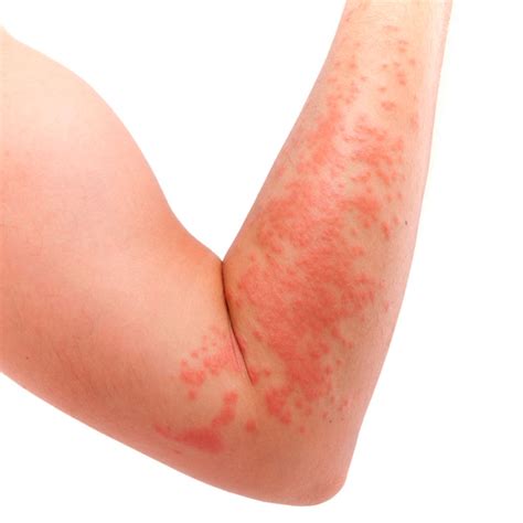 Alergia Al Sol Causas Síntomas Y Tratamientos