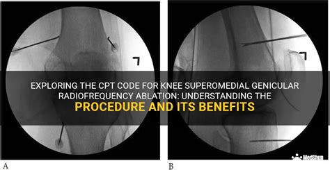 Exploring The Cpt Code For Knee Superomedial Genicular Radiofrequency