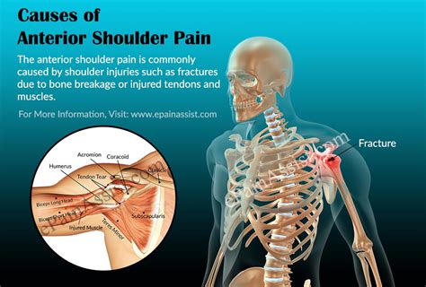 Bursa and ligament of the anterior shoulder. What is Anterior Shoulder Pain|Causes|Symptoms|Treatment ...