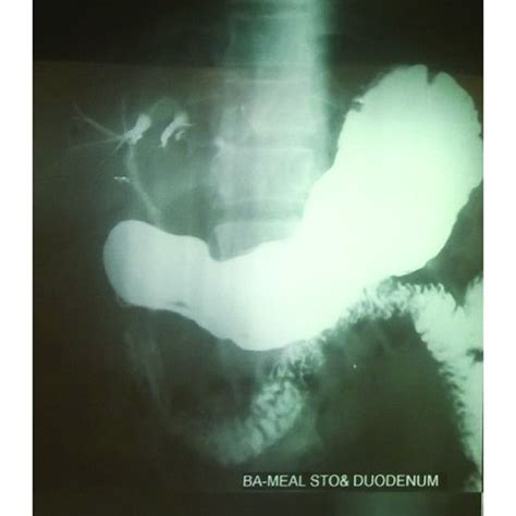 Endoscopy Image Showing Opening Of Fistula In The Posterior Duodenal