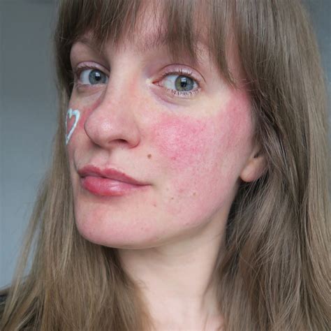 My Rosacea Story With Eau Thermale Avène Ad