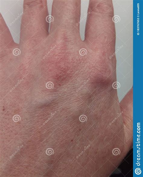 Rash And Hives On The Skin Of The Back Of The Female Hand Allergic