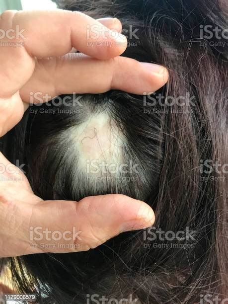 The Man Spreads The Hair On The Womanâs Head With His Fingers You Can