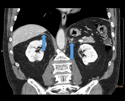 Adrenal Ct 2 Months Later Almost Total Regress Of The Right Dorsal