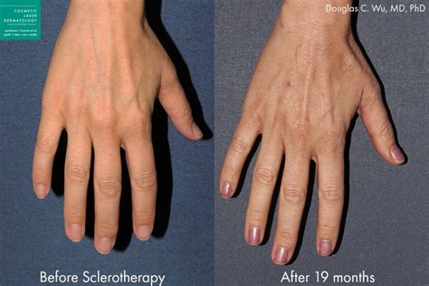 Hand Rejuvenation San Diego Ca Cosmetic Laser Dermatology