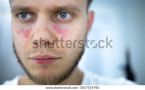 Age Spots Redness On Face Young Stock Photo Edit Now 1817519783