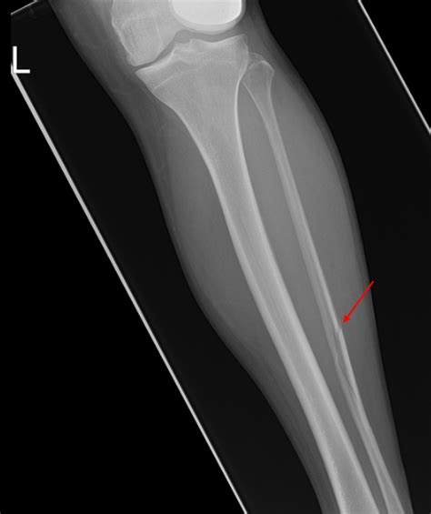 Tibia And Fibula Fractures Ankle