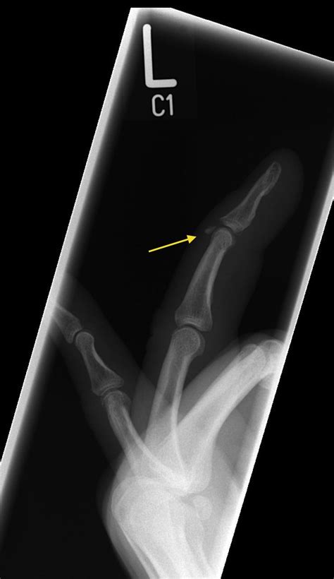 Mallet Finger Radiology At St Vincents University Hospital