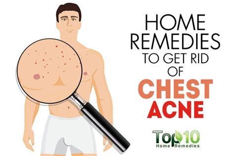 Home Remedies To Get Rid Of Chest Acne Top 10 Home Remedies