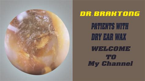 Eardrum Peel And Foreign Body Removal Patients With Dry Ear Wax Youtube