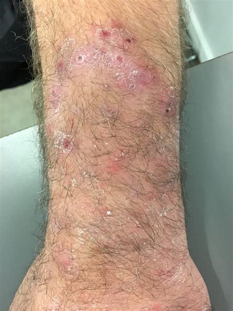 Annular Scaling Plaque On The Outer Left Forearm Of A 58 Year Old Man