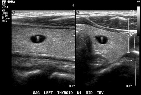 Inspissated Colloid In A Thyroid Nodule Radiology Case