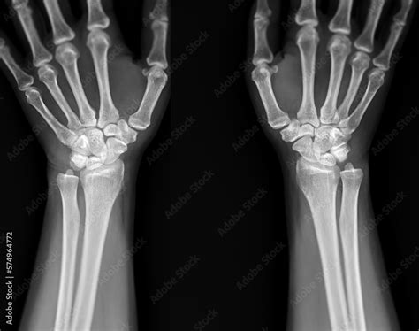 X Ray Image Of Wrist Joint Front View Of Normal Wrist Joint Stock Foto