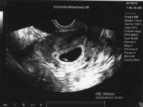 In the case of a 6 weeks pregnant ultrasound, your doctor may be able to detect a fetal heartbeat or see a fetal pole, or even two gestational sacs if you're having twins. These Things I'd Never Say: 6 week ultrasound