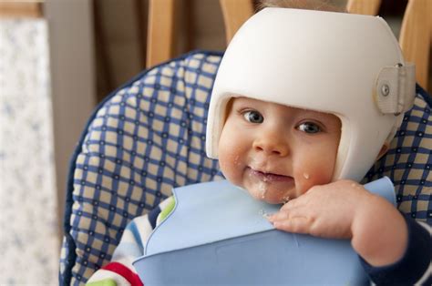 What You Need To Know About Plagiocephaly Flat Head Syndrome