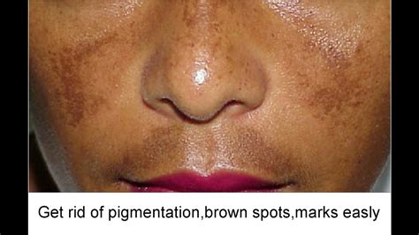 How To Get Rid Of Face Pigmentation With Easy Home Remedies Super