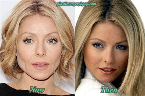 Kelly Ripa Plastic Surgery Before After Pictures Celebrity Plastic