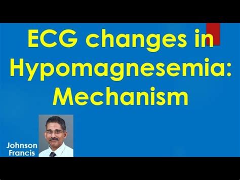ECG Changes In Hypomagnesemia Mechanism YouTube