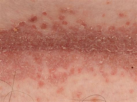 Intertrigo is an inflammatory skin condition that can be caused and worsened if you or your child has intertrigo, your doctor may suggest simply keeping the affected area dry and. Intertrigo (smetplekken, intertrigineus eczeem)