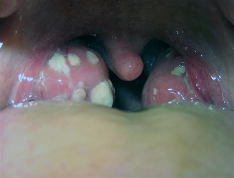White Spots Patches Bumps On Tonsils Causes Stds