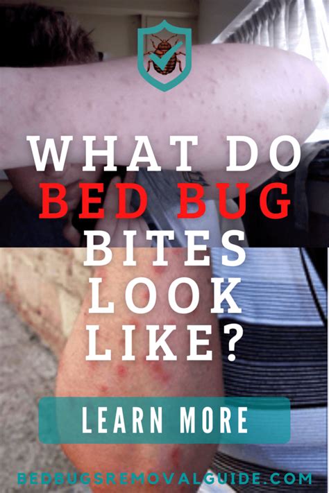 What Do Bed Bug Bites Look Like Images Wallmost