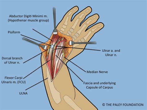 The Paley Ulnarization Of The Carpus With Ulnar Shortening Osteotomy