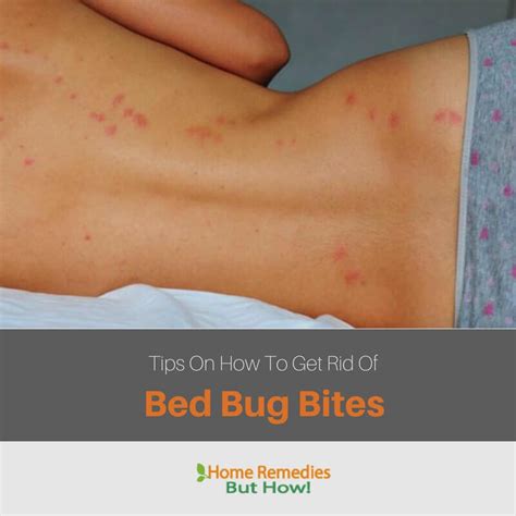 Bed Bugs Bites Home Remedy Home Mybios