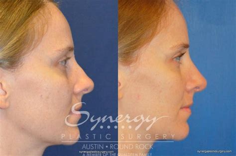 Rhinoplasty Before And After Pictures Case Austin TX Synergy Plastic Surgery